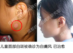 小孩脸上白斑,脸上白斑,什么病【详解】(图)