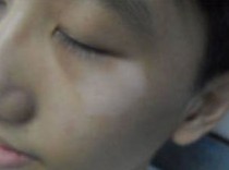 小孩脸上白斑,脸上白斑,什么病【详解】(图)