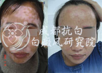 白斑患者忌吃什么