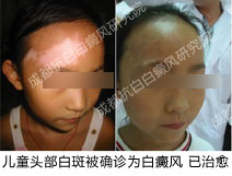 成都抗白,成都白斑医院,儿童白斑治疗