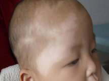 成都白斑,成都白斑医院,宝宝脸上有白斑什么病,图