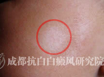 �ɶ��װ�,�ɶ��װ�ҽԺ,�װ߰װ�����֢״ʲô������ͼ��