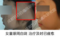 成都白斑,成都白斑医院,白斑初期能吗,图